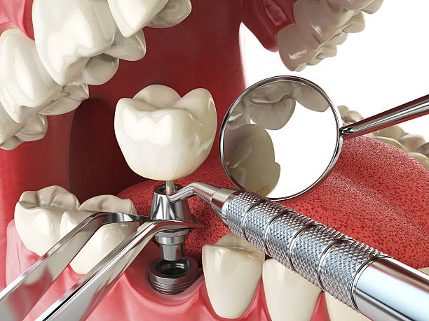 Best Emergency Wisdom Teeth Removal in Catahou, LA