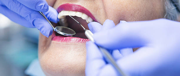 Best Emergency Wisdom Teeth Removal in Catahou, LA